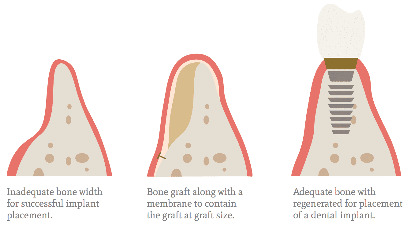 Bone Grafting the woodlands tx