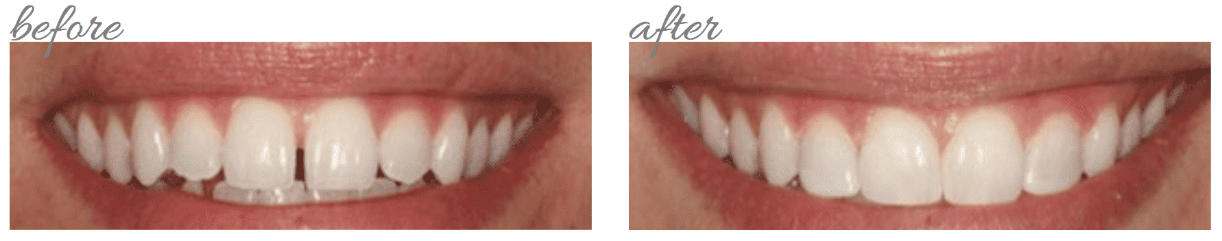 Cosmetic Bonding from Carrie Muzny Image