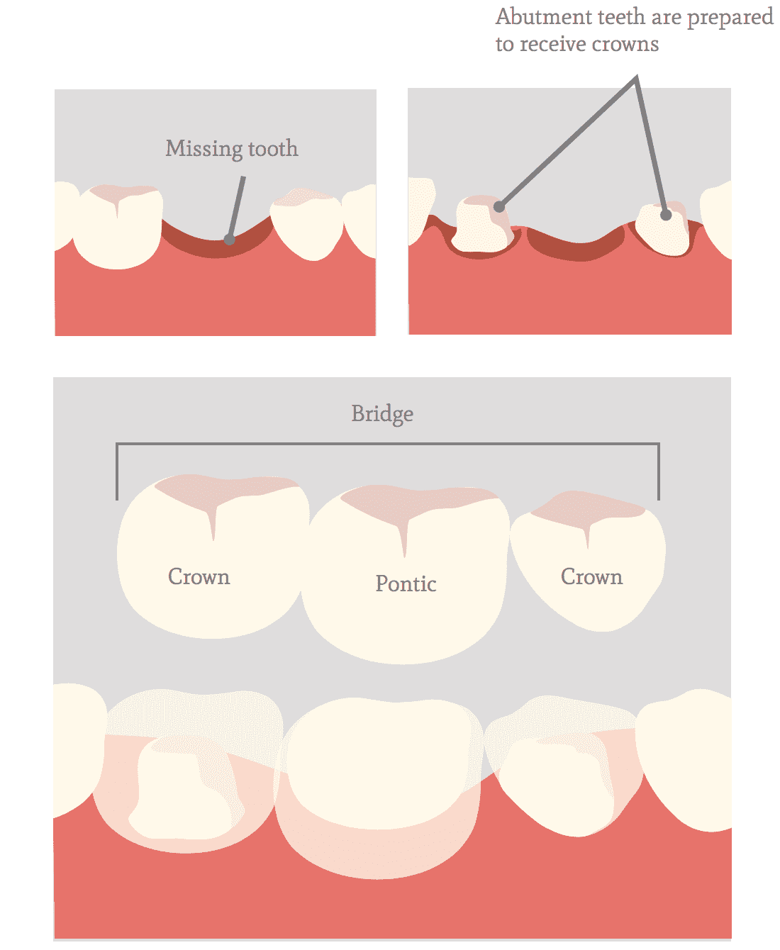 How A Bridge Works Dentistry