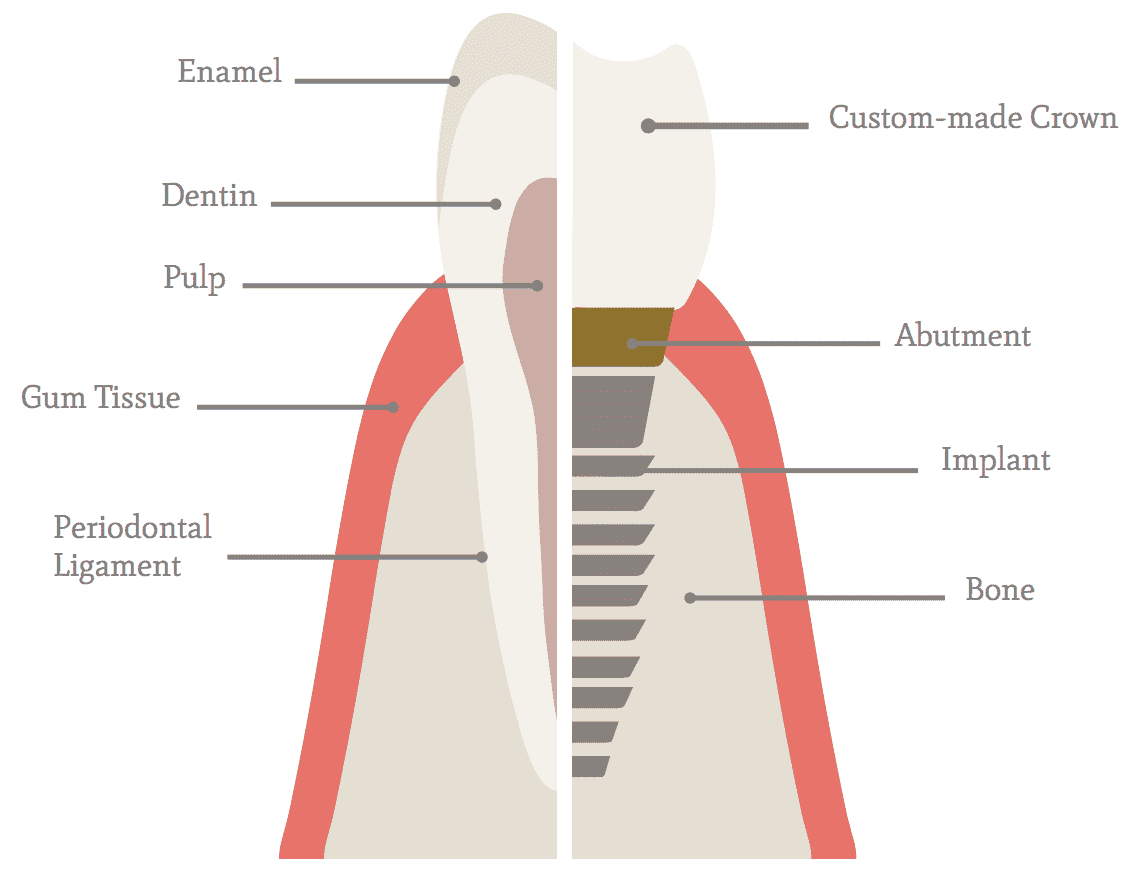 Implant Diagram