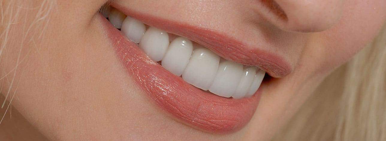 Porcelain veneers in The Woodlands Texas.