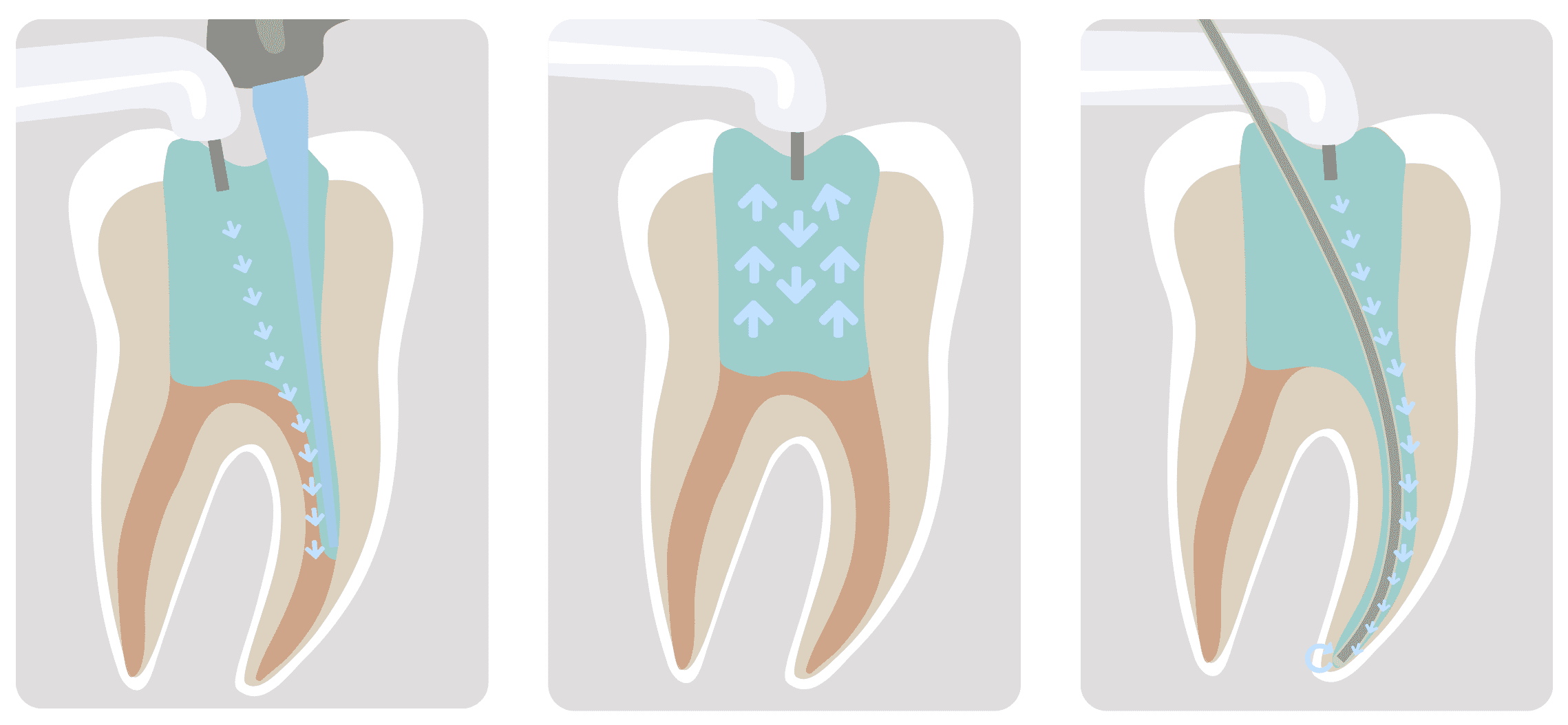 Root Canals Explanation
