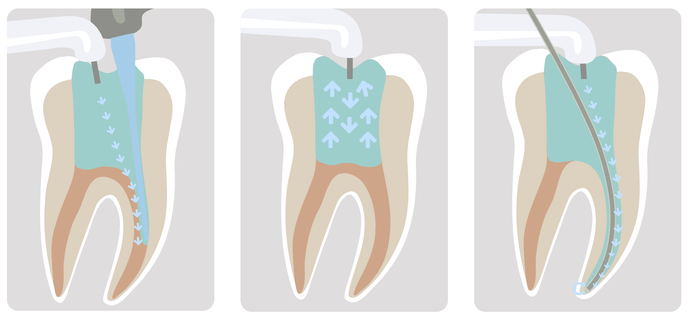 Root canals in The Woodlands, Tx from Carrie Muzny, DDS. 