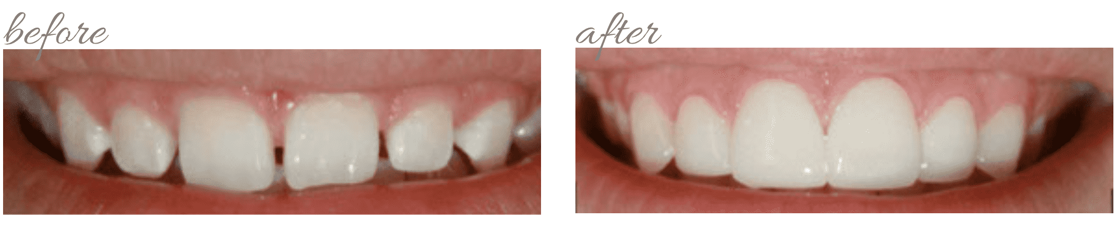 Smile Makeover from Carrie Muzny DDS Image