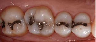 Metal Fillings on teeth