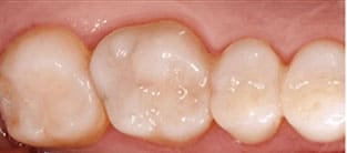 Composite White Fillings from Dr. Carrie Muzny DDS
