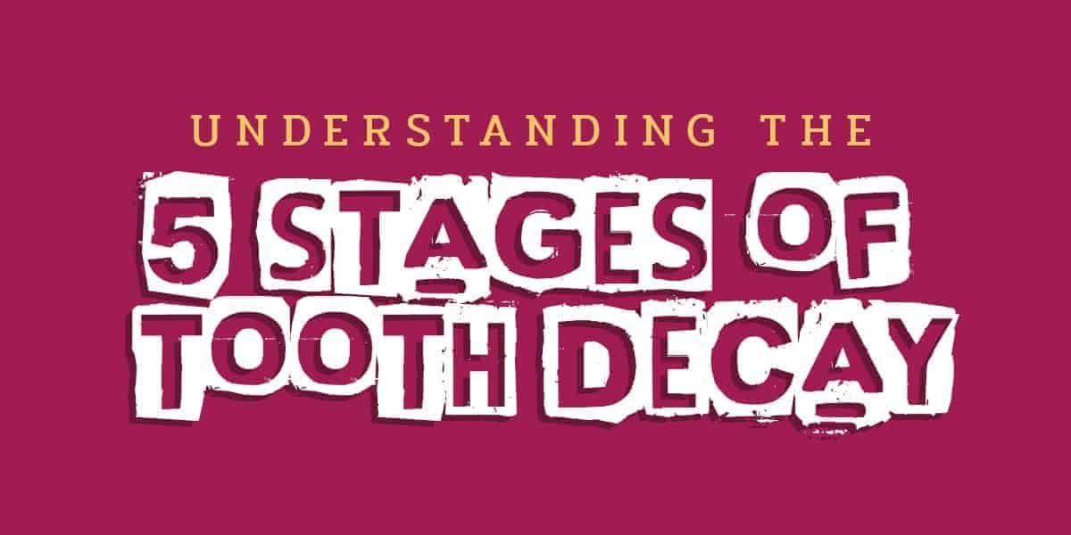 5 Stages of Tooth Decay cover 5 Stages of Tooth Decay cover