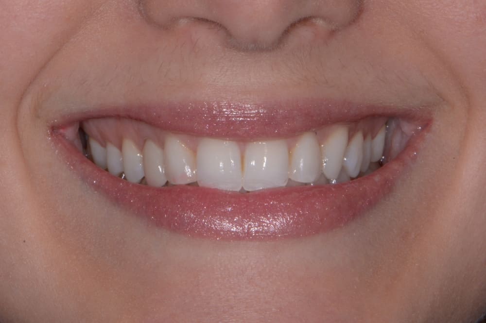 lips smiling showing upper and lower teeth after dental work