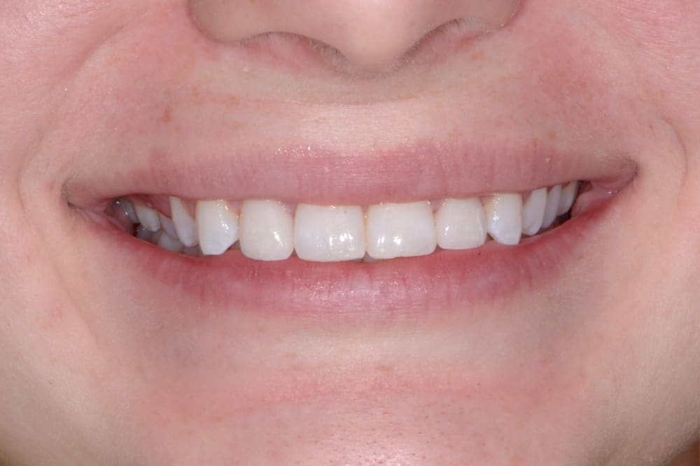 lips smiling showing upper and lower teeth after dental work