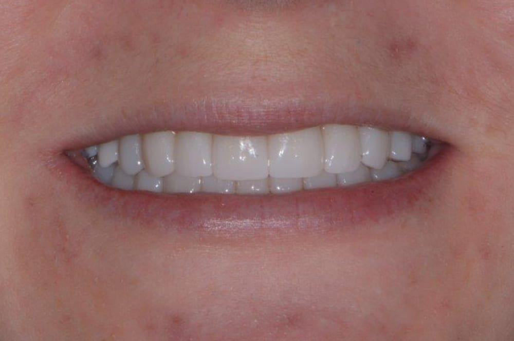 open lips showing upper and lower teeth after dental work
