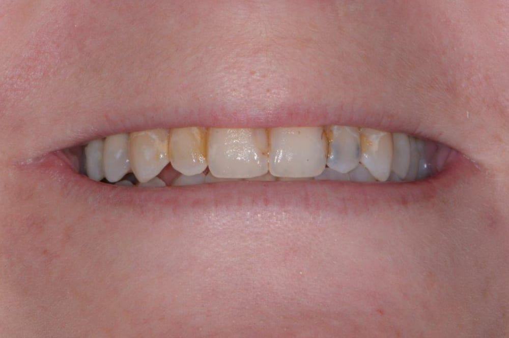 open lips showing stained upper and lower teeth before dental work