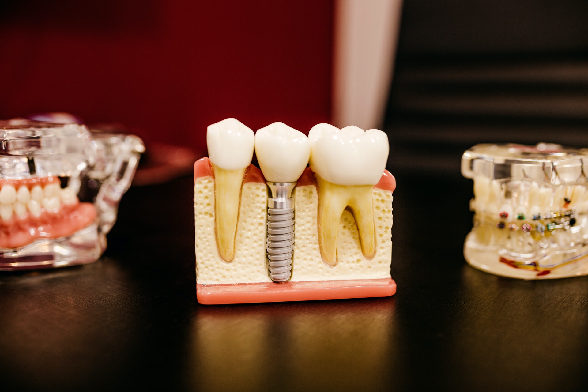 dental implant illustration