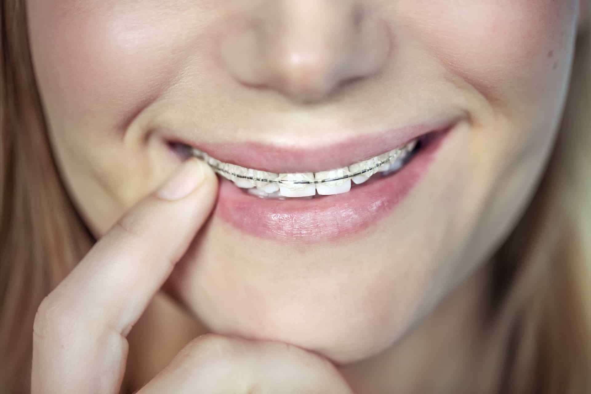 Closeup photo of a beautiful smile of a teen girl with braces, aesthetic dentistry, contemporary fixing of the teeth, health and dental care