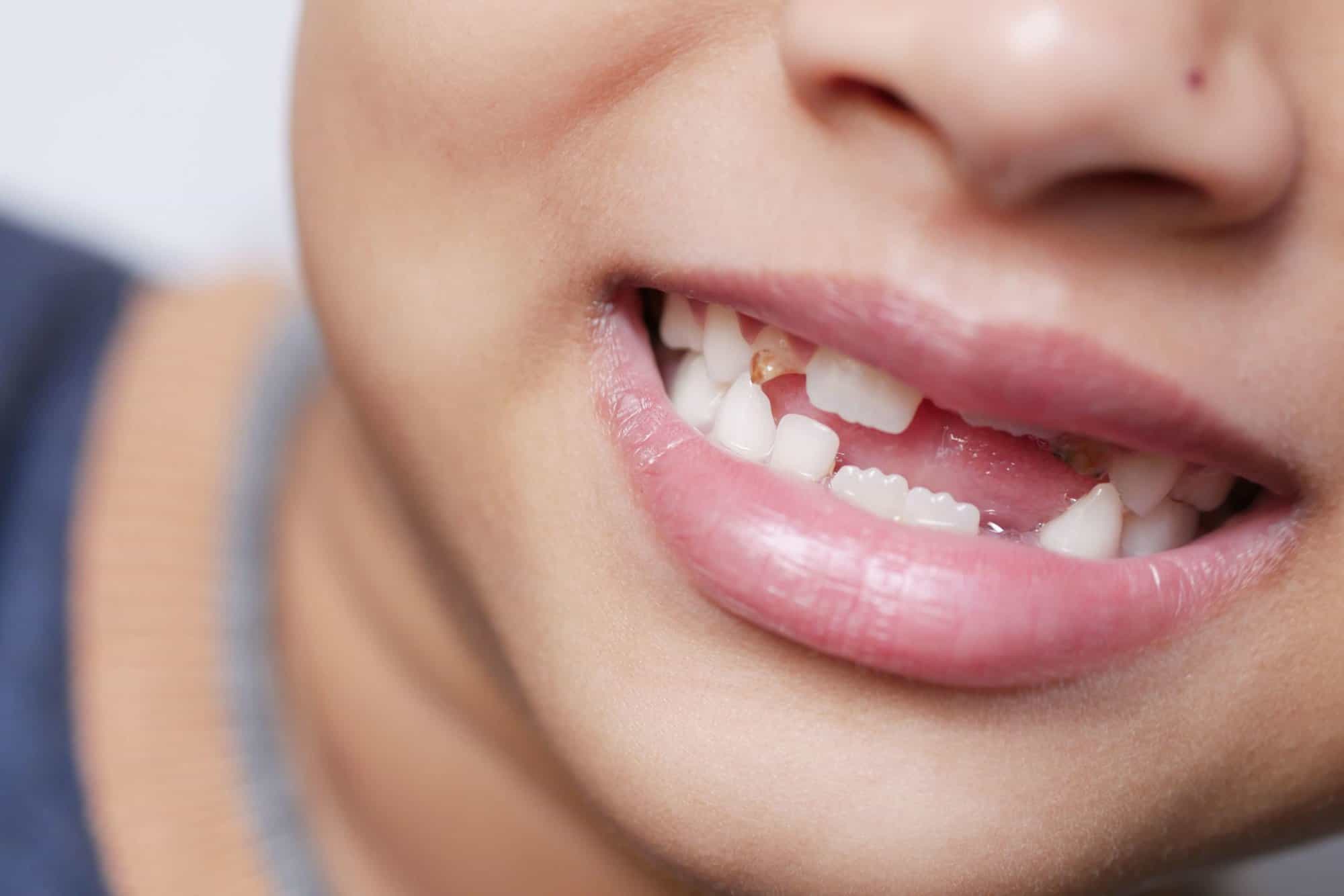 Craze Lines on Teeth: Are My Teeth Cracked?