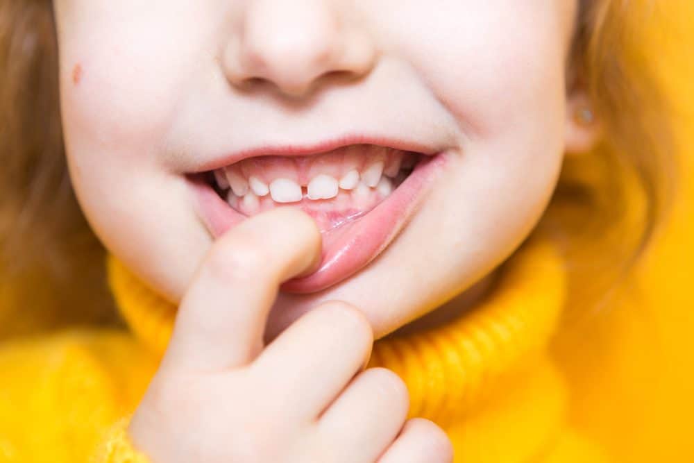 girl shows her overbite teeth