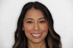 Aesthetic dentistry patient after upper veneers and gum lift