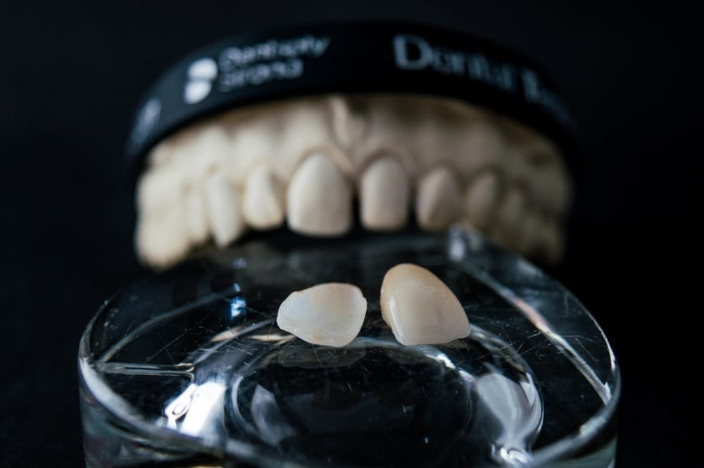 veneers for gapped teeth
