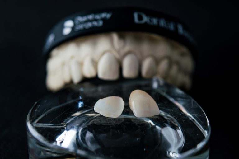 veneers for gapped teeth