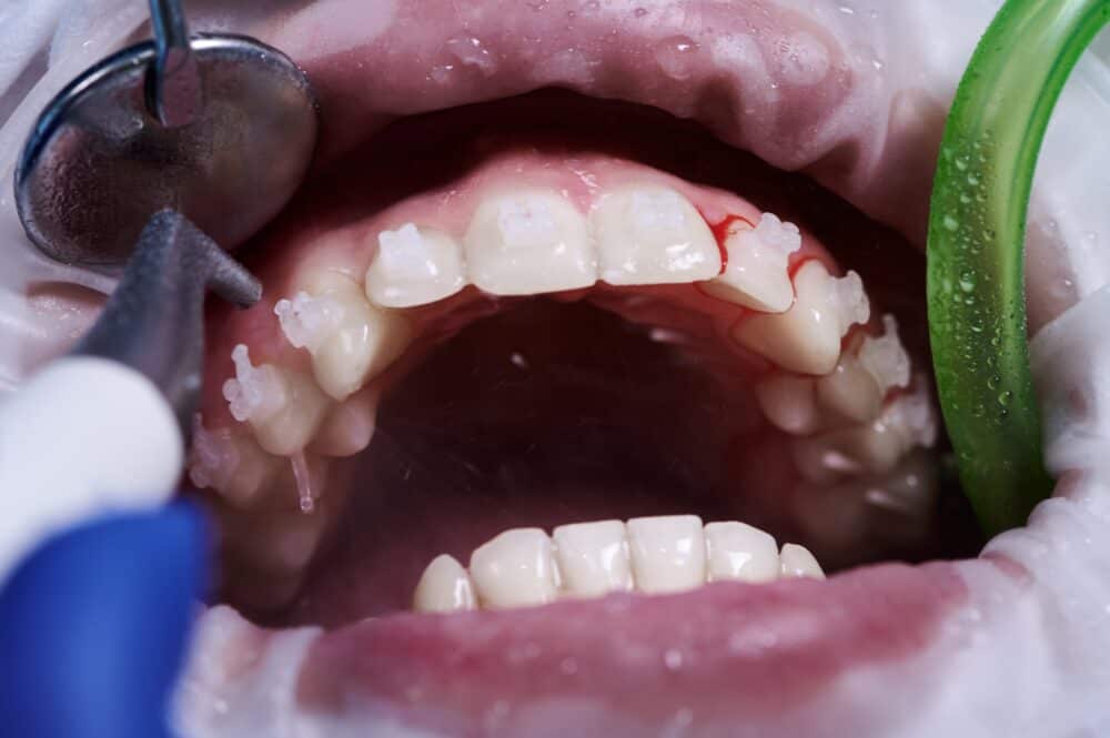 bleeding gums after dental cleaning