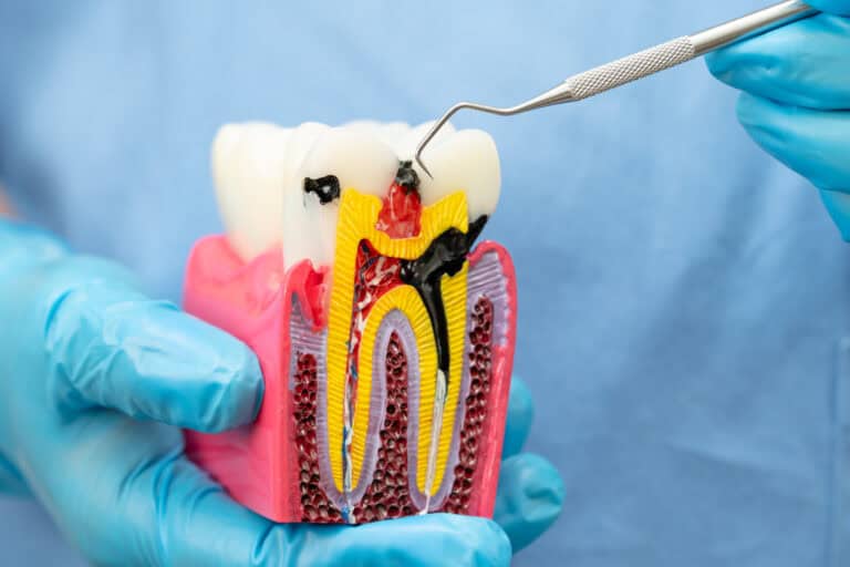 what happens if you delay a root canal